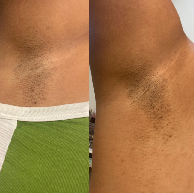 Nexiva Intimate Area Brightening Gel
